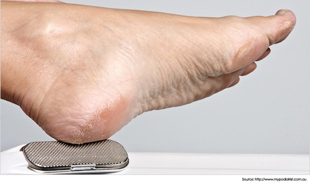 Tumit kaki kering dan merekah, cara atasi tumit kering merekah, cara lembutkan tumit kering  merekah