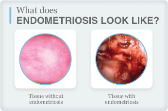 Perbezaan antara sel tisu normal dan endometriosis