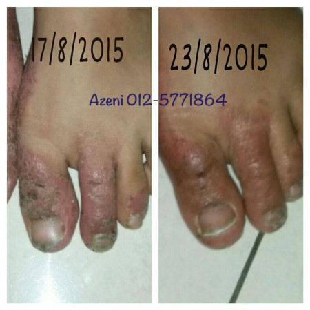 Cara rawat ekzema teruk