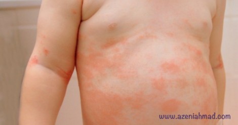 Cara rawat ekzema teruk