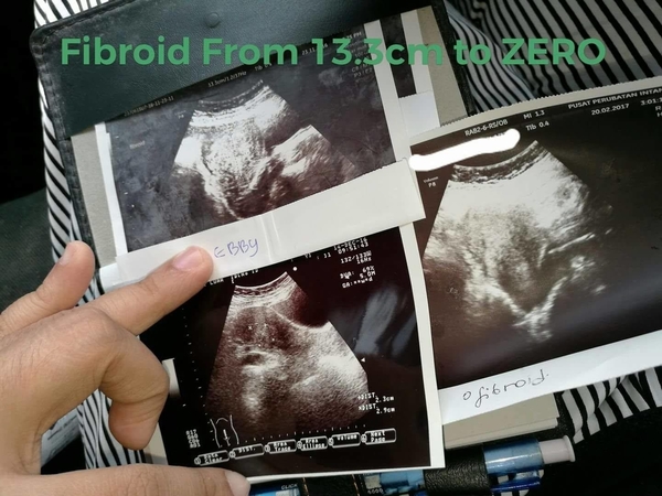 cara kecutkan fibroid besar