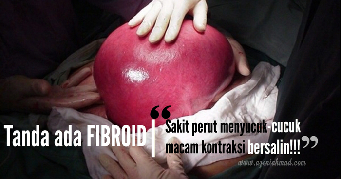 cara kecutkan fibroid tanpa pembedahan