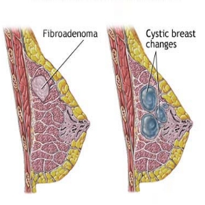 Apa itu fibroadenosis dan fibroadenomas 